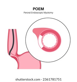 Peroral endoscopic myotomy. POEM minimally invasive procedure. Disorder of the esophagus, achalasia disease. Closed lower esophageal sphincter, gastroesophageal anatomical poster vector illustration