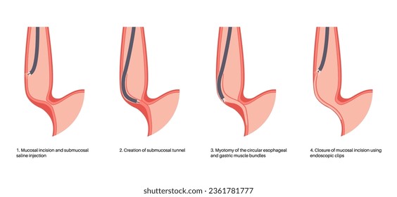 Peroral endoscopic myotomy. POEM minimally invasive procedure. Disorder of the esophagus, achalasia disease. Closed lower esophageal sphincter, gastroesophageal anatomical poster vector illustration