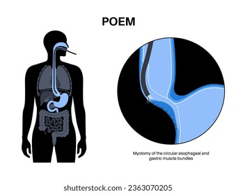 Peroral endoscopic myotomy. POEM minimally invasive procedure. Disorder of the esophagus, achalasia disease. Closed lower esophageal sphincter, gastroesophageal anatomical poster vector illustration