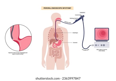 Peroral endoscopic myotomy. POEM minimally invasive procedure. Disorder of the esophagus, achalasia disease. Closed lower esophageal sphincter, gastroesophageal anatomical poster vector illustration