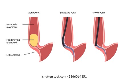 Peroral endoscopic myotomy. POEM minimally invasive procedure. Disorder of the esophagus, achalasia disease. Closed lower esophageal sphincter, gastroesophageal anatomical poster vector illustration