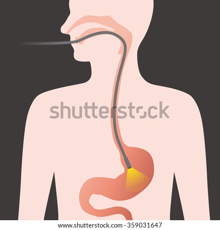 peroral endoscopy, endoscope, vector illustration
