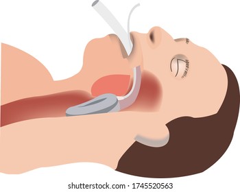 person with artificial re-response tube