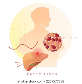 Person with Fatty Liver - Stock Illustration as EPS 10 File