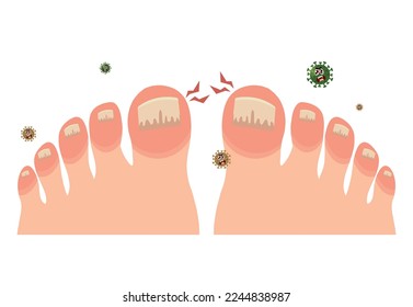 Person feet with nail disease or infection. Foot with onychomycosis or fungus on fingers. Medical treatment and procedure. Healthcare and medicine concept. Flat vector illustration.