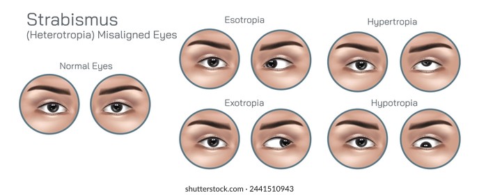 In a person with strabismus, the eyes may not align properly, This misalignment can be constant or intermittent and may affect one or both eyes. Syndrome and conditions diseases vector illustration.