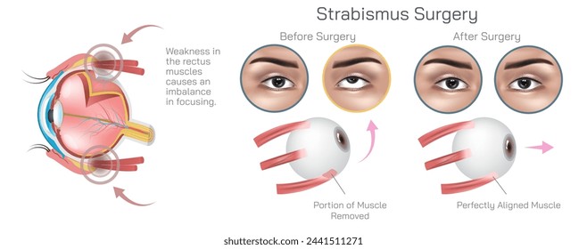 In a person with strabismus, the eyes may not align properly, This misalignment can be constant or intermittent and may affect one or both eyes. Syndrome and conditions diseases vector illustration.