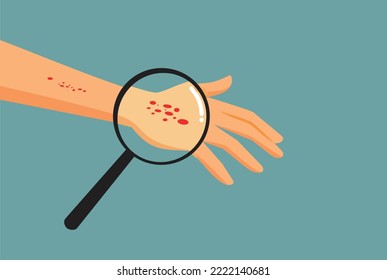 
Person Suffering a Rash on His Hand Vector Medical Concept Illustration. Hand with red dots symptom of skin condition 
