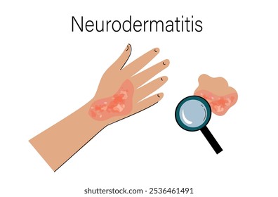 Person suffers from atopic dermatitis. Neurodermatitis symptoms and reasons infographic. Human skin infection dermatitis diagnosis. Vector doodle hand drawn flat illustration