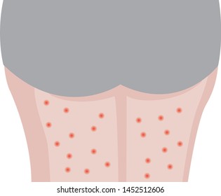Person's legs affected with eczema skin disease vector illustration Dermatology problem