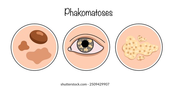 Fakomatoses. Doença progressiva hereditária caracterizada por lesões combinadas na pele, olhos e sistema nervoso. Manifestações externas atraídas da doença. Vetor dermatológico.