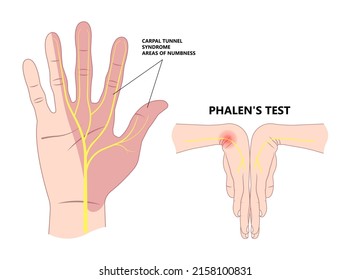 Phalen test diagnose wrist flexion bend hand nerve compression pain treat ache arm weak thump tinel sign elbow ulnar guyon canal  two point numb durkan tendon exam de quervain's