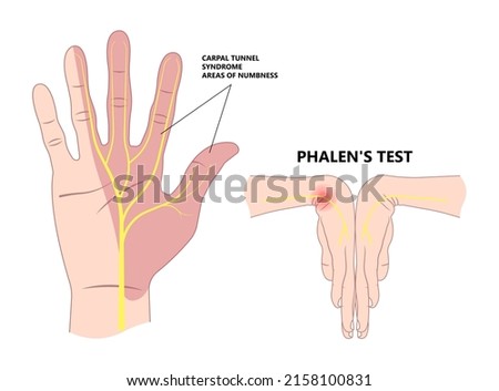 Phalen test diagnose wrist flexion bend hand nerve compression pain treat ache arm weak thump tinel sign elbow ulnar guyon canal  two point numb durkan tendon exam de quervain's