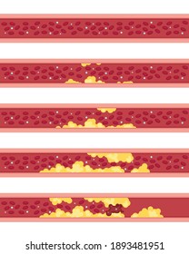 Phases of atherosclerosis vector illustration