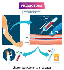 Phlebotomy vector illustration. Labeled veins blood samples process scheme. Explanation medical venipuncture closeup diagram. Needle procedure for test research. Professional phlebologist occupation.