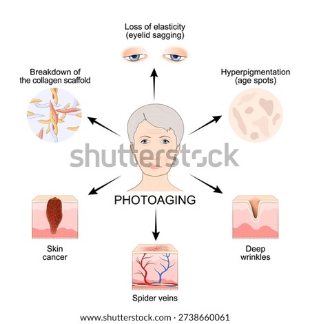 Photoaging. Symptoms of the skin aging process. Facial skin sags due to loss of collagen and elastin, hyperpigmentation from exposure to UV rays. Vector illustration. Medical diagram