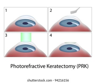 Photorefractive Keratectomy (PRK) eye surgery