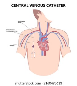 PICC Line insert neck tube vein arm blood draws heart IV needle cancer therapy Total peripheral internal double lumen chest port fluid injection large artery superior vena cava care drug implantation