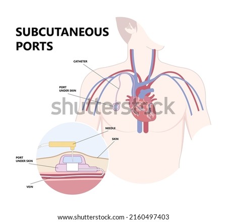 PICC Line insert neck tube vein arm blood draws heart IV needle cancer therapy Total peripheral internal double lumen chest port fluid injection large artery superior vena cava care drug implantation