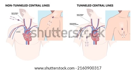 PICC Line insert neck tube vein arm blood draws heart IV needle cancer therapy Total peripheral internal double lumen chest port fluid injection large artery superior vena cava care drug implantation