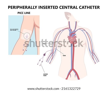PICC Line insert neck tube vein arm blood draws heart IV needle cancer therapy Total peripheral internal double lumen chest port fluid injection large artery superior vena cava care drug implantation