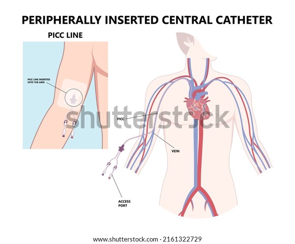 PICC Line insert neck tube vein arm blood\
draws heart IV needle cancer therapy Total peripheral internal\
double lumen chest port fluid injection large artery superior vena\
cava care drug\
implantation