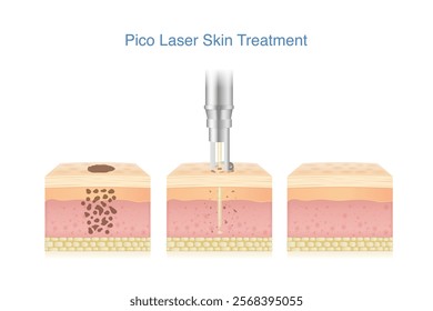 Pico laser treatment dark spot on skin layer 3 steps. Breaking and fades away dark spot on facial skin by shoot Pico laser passes skin layer for removal. Can be used on tattoos, freckles, and Melasma.