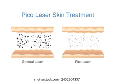 Picosecond Laser skin treatment compare with General Laser. Reduce freckles, blemishes, wrinkles by breaks pigments into smaller fragments