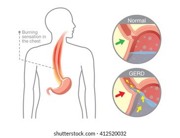 Picture Of Human Stomach In Problem Area Have Acid Back Up Into Esophagus Which Is Cause Gastroesophageal Reflux Disease.