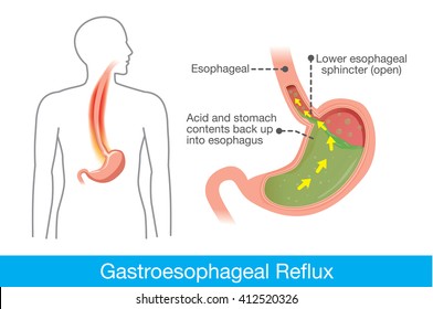 Picture Of Human Stomach In Problem Area Have Acid Back Up Into Esophagus Which Is Cause Gastroesophageal Reflux Disease