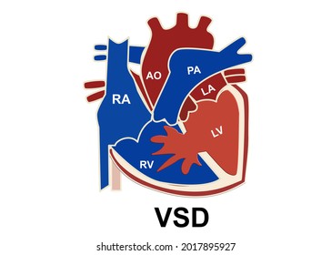 La imagen muestra la estructura del corazón que tiene defecto entre ventrículo del corazón izquierdo y derecho llamado defecto septal ventricular o vsd para concepto médico y educativo