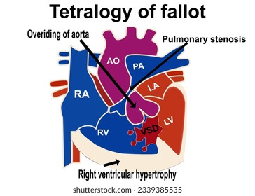 The picture show the structure of tetralogy of fallot that show the 4 part defect of heart which is overriding of aorta , pulmonary stenosis  ,VSD, right ventricular hypertrophy for medical concept