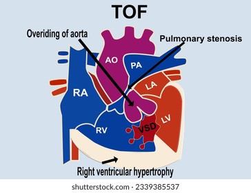 The picture show the structure of tetralogy of fallot that show the 4 part defect of heart which is overriding of aorta , pulmonary stenosis  ,VSD, right ventricular hypertrophy for medical concept