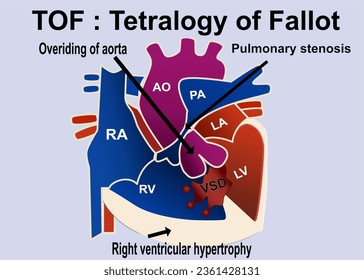 The picture show the structure of tetralogy of fallot that show the 4 part defect of heart which is overriding of aorta , pulmonary stenosis  ,VSD, right ventricular hypertrophy for medical concept