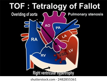 The picture show the structure of tetralogy of fallot that show the 4 part defect of heart which is overriding of aorta , pulmonary stenosis  ,VSD, right ventricular hypertrophy for medical concept