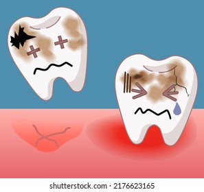 Picture of tooth decay, gingivitis and tooth extraction ,Dental medical illustrations