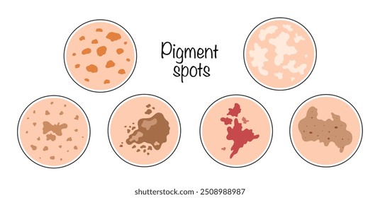 Manchas de pigmento. Ilustração de vetor de cores com diferentes tipos de pontos de idade. Conjunto de formações cutâneas. Ilustração para uso no campo da medicina e cosmetologia.