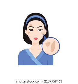 Pigment Spots on a Beautiful Japan Woman Face. Asian Woman with Problematic Skin. Close up of Skin Pigment Spots. Zoom. Colorful Cartoon style. White background. Vector illustration for Medical Design