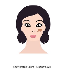 Pigmentation on the skin. A pigmented spot on the skin of the face. Vector illustration