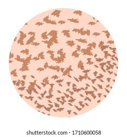 Pigmentation on the skin. A pigmented spot on the skin of the face. Vector illustration