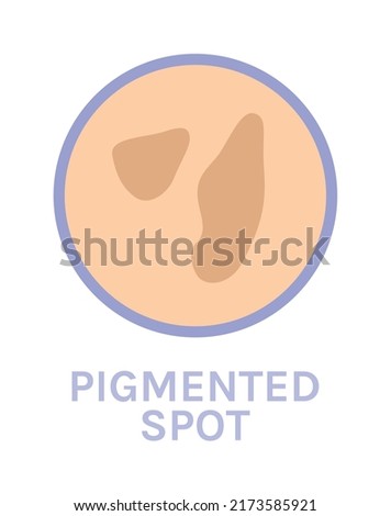 Pigmented Spots on the Skin. Skin Problem. Pigmentation. Closeup Brown Spots. Icon. Color Cartoon style. White background. Vector illustration for Beauty and Medical Design.
