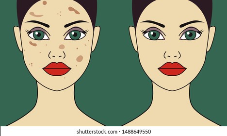 Piigment spots on female face, laser treatment of hyperpigmentation. Vector illustration