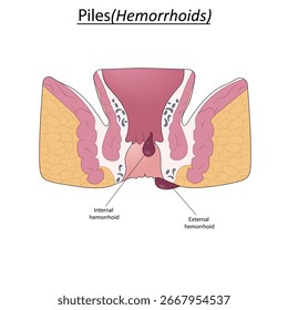 Pile (Hemorrhoids) in anus vector illustration