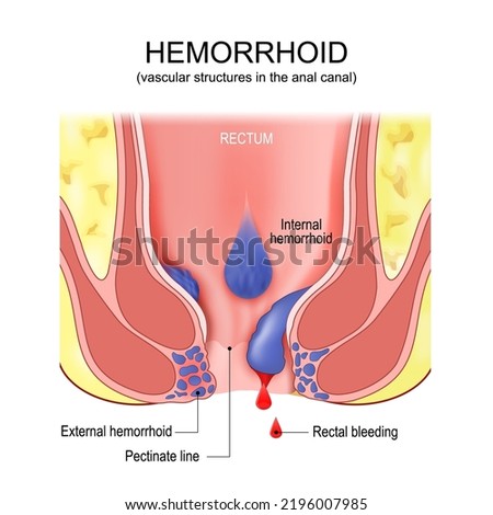 piles. hemorrhoidal disease. anatomy of internal and external hemorrhoids. Cross section of the rectum and anal canal with Pectinate line. examine rectum pain and Rectal bleeding. Vector poster