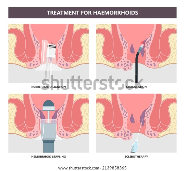 Piles swollen blood anus treat band surgical home\
sitz baths colon cancer examine rectum pain ligator clots stapler\
PPH Laser regular lump Digital anal canal thrombectomy thrombosis\
fistula removal