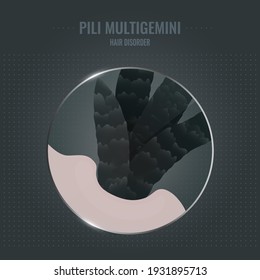 Pili multigemini hair disorder surface under microscope. Multiple hair shafts ingrowth condition closeup vector. Trichology medical concept.