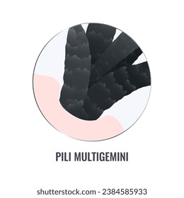 Pili multigemini hair disorder surface under microscope. Multiple hair shafts ingrowth condition closeup vector. Trichology medical concept.