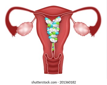 Pills inside uterus. Reproductive system treatment with pills