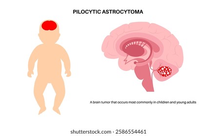 Pilocytic astrocytoma medical poster. Slow growing type of primary central nervous system tumor. Cerebellum disease. Neoplasm in the child silhouette. Problems with balance, coordination, optic nerve