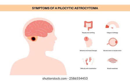 Pilocytic astrocytoma symptoms in child vector. Type of primary central nervous system tumor. Cerebellum disease. Neoplasm in the child silhouette. Problems with balance, coordination, and optic nerve